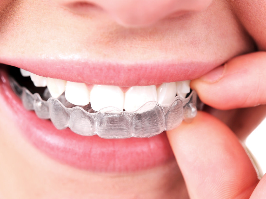 Why Do Most Dentists Prefer Invisalign For Orthodontic Solutions?